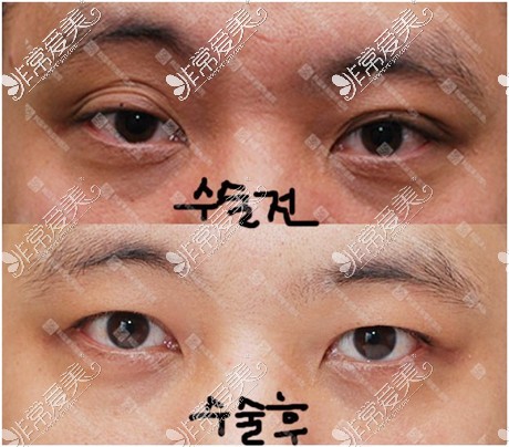 韩国来丽整形双眼皮改单眼皮成功对比图