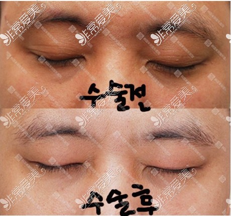 韩国双眼皮改单眼皮日记分享!这家医院双眼皮改单太哇塞了