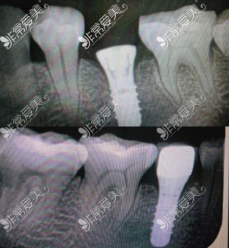 种植牙术后CT拍摄图