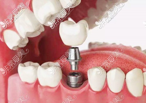 种植牙口腔3D图示