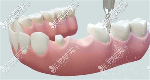 做搭桥牙修复前打磨牙齿