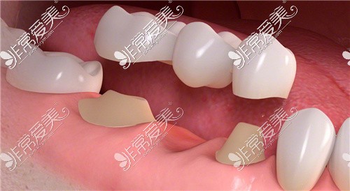 牙齿搭桥修复