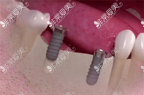 连续缺三颗牙种二得三修复方式示意图