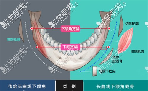 传统下颌角和长曲线下颌角