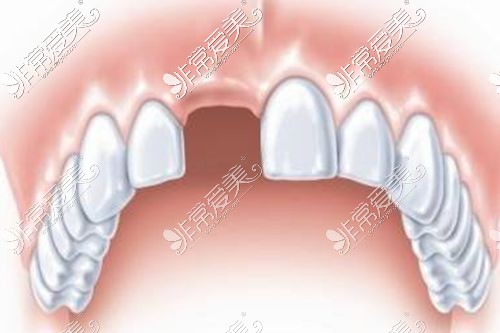 单颗牙缺失