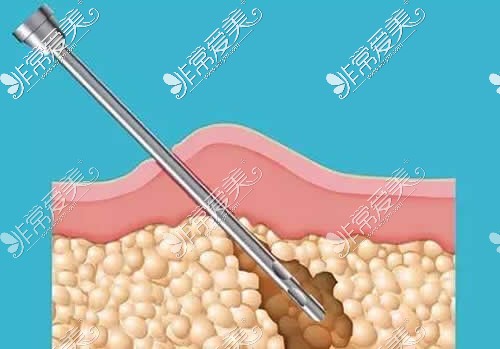 吸脂手术卡通示意图