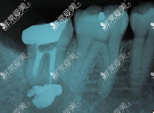 根管后牙齿图片