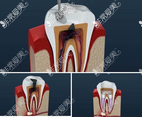 牙齿根管治疗图