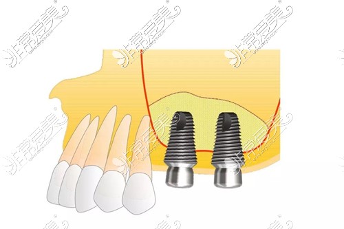 上颌窦外提升步骤3示意图