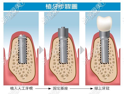 戴牙冠的过程图解图片