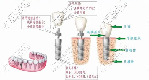 种植牙结构展示图