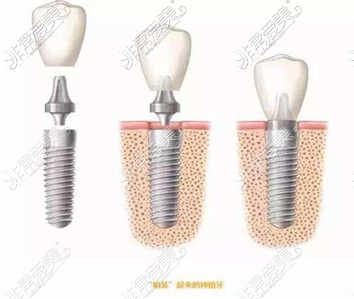 埋入式种植牙示意图