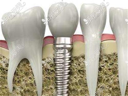 埋入式种植牙示意图