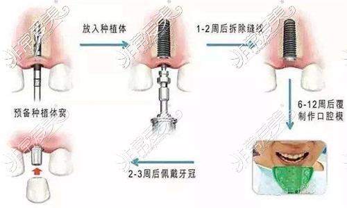 种植牙流程示意图