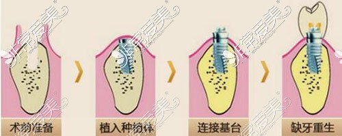 種植牙過程示意圖