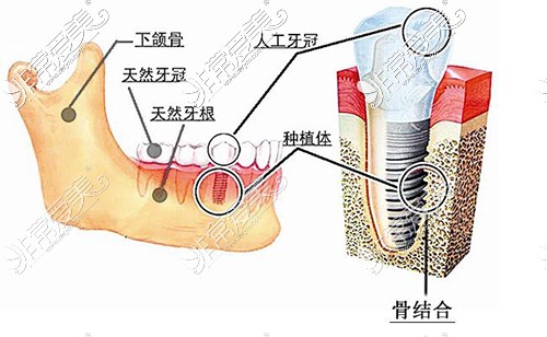 种植牙结构图示