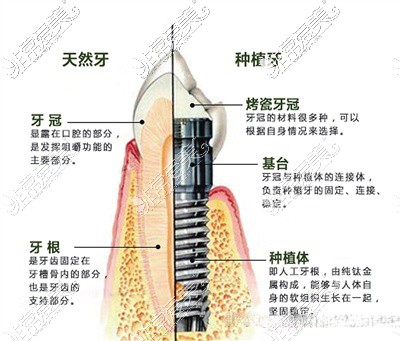 种植牙及天然牙功能结构图示