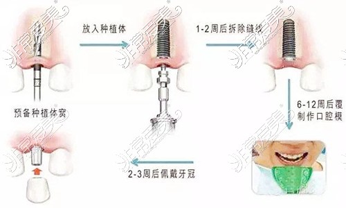 种植牙流程图示