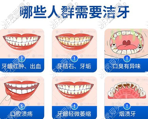 哪些牙齿需要做洁牙改善治疗