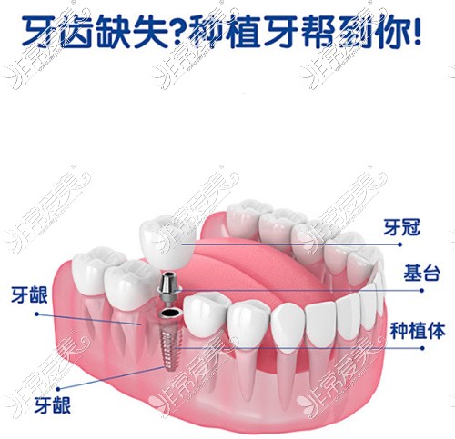 種植牙動(dòng)畫圖