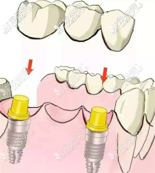 种植牙动画图示