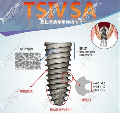 奥齿泰TS IV疏松骨质专用种植体图示
