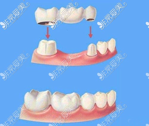 冠橋修復(fù)缺失牙動(dòng)畫圖