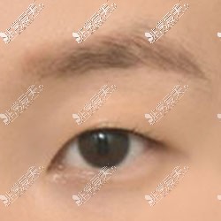 韩国icon双眼皮整形术前照
