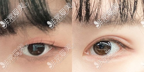 韩国icon双眼皮手术对比照