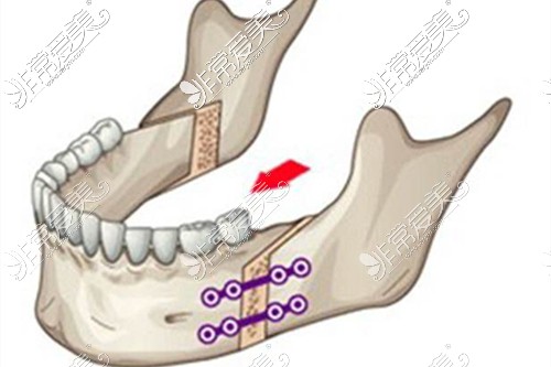 正颌手术操作展示图