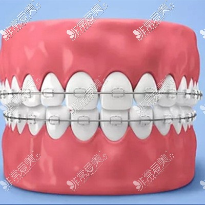 牙齿矫正过程图