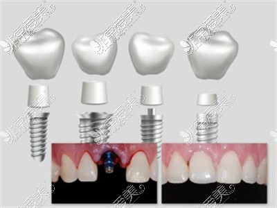 奥齿泰植体陈列及种植前后对比