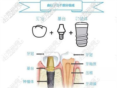 奧齒泰植體結(jié)構(gòu)解析