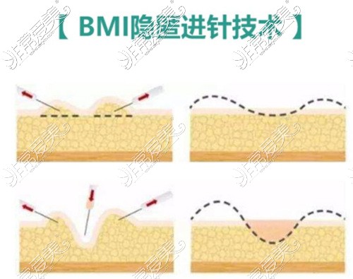 长沙梵童整形吸脂进针技术