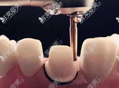 磨牙改善治疗展示