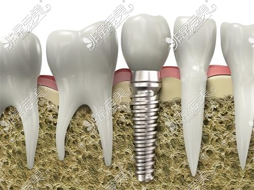 种植牙示意图
