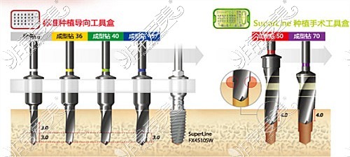 登騰種植牙系統(tǒng)