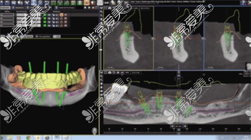 登腾种植牙CT图