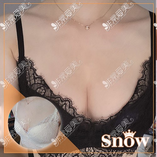 韩国snow隆胸手术图片