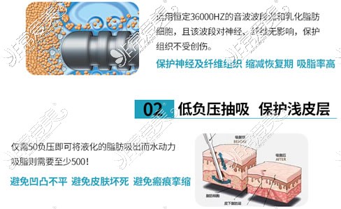 土麦森吸脂技术特点分析