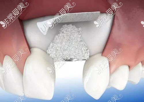 牙槽植骨术示意图
