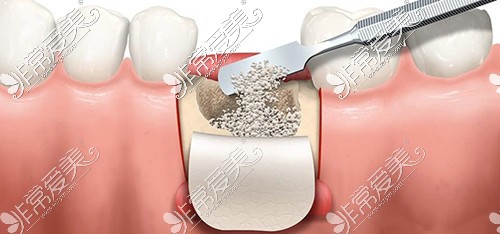 牙槽植骨操作图示