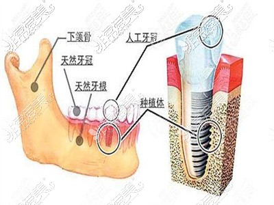 牙齿缺失但是缝隙不够种牙怎么办？可以直接关闭缝隙