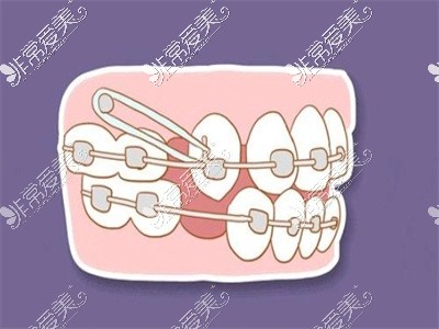 正畸填补修复牙齿缺失