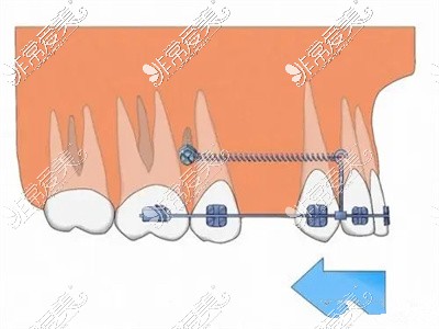 正畸牵引牙齿填满缺失牙位过程