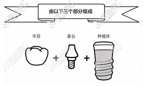 种植牙的组成部分