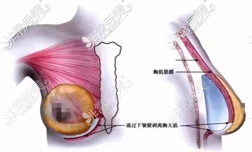 假体隆胸双平面下腔隙植入演示
