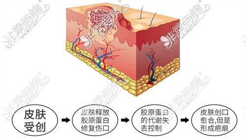 皮肤受创的过程及影响