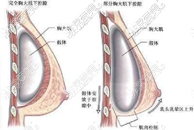 假体隆胸植入层次示意图