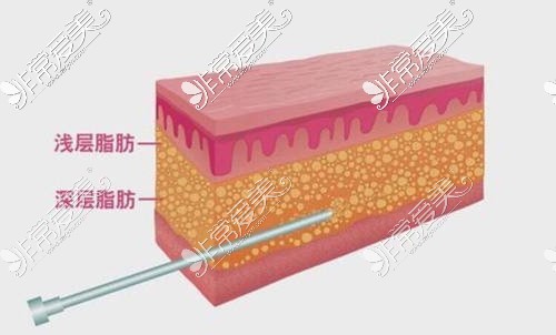 贵阳自体脂肪填充哪家好？日记分享看哪家整形正规